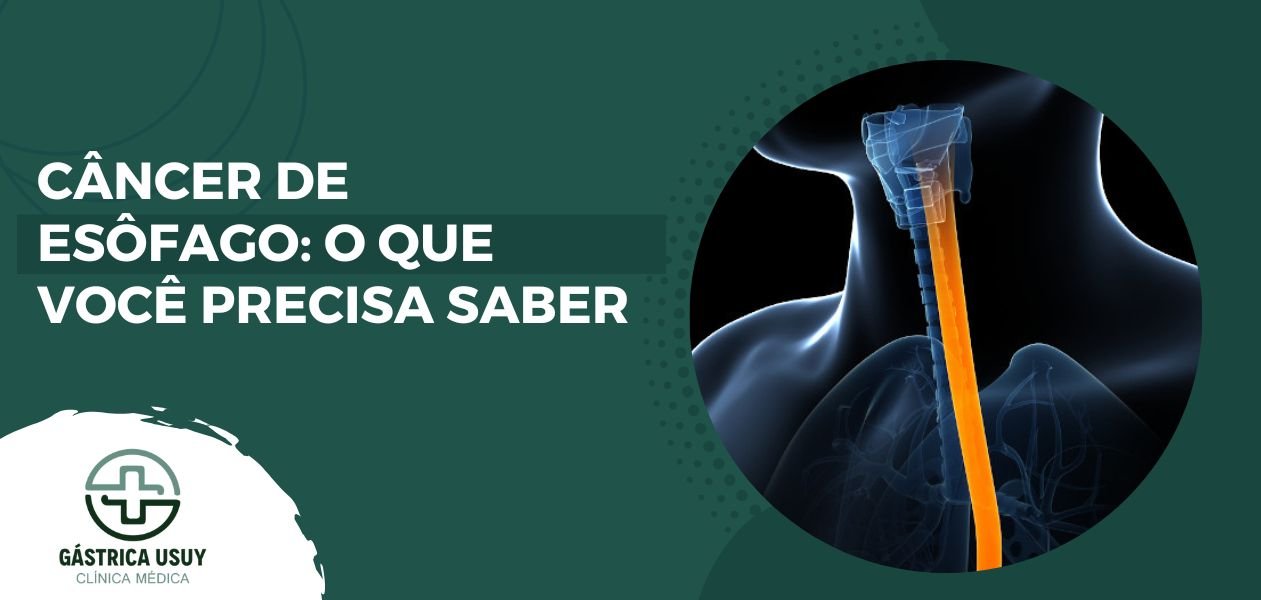 Banner ilustrativo com o título "Câncer de Esôfago: O que você precisa saber" e imagem do esôfago humano destacando sua anatomia, representando o conteúdo informativo sobre diagnóstico, prevenção e tratamento do câncer de esôfago.