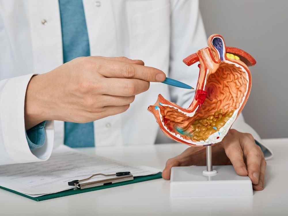 Profissional da saúde apontando modelo anatômico do estômago ao explicar o funcionamento do balão gástrico.