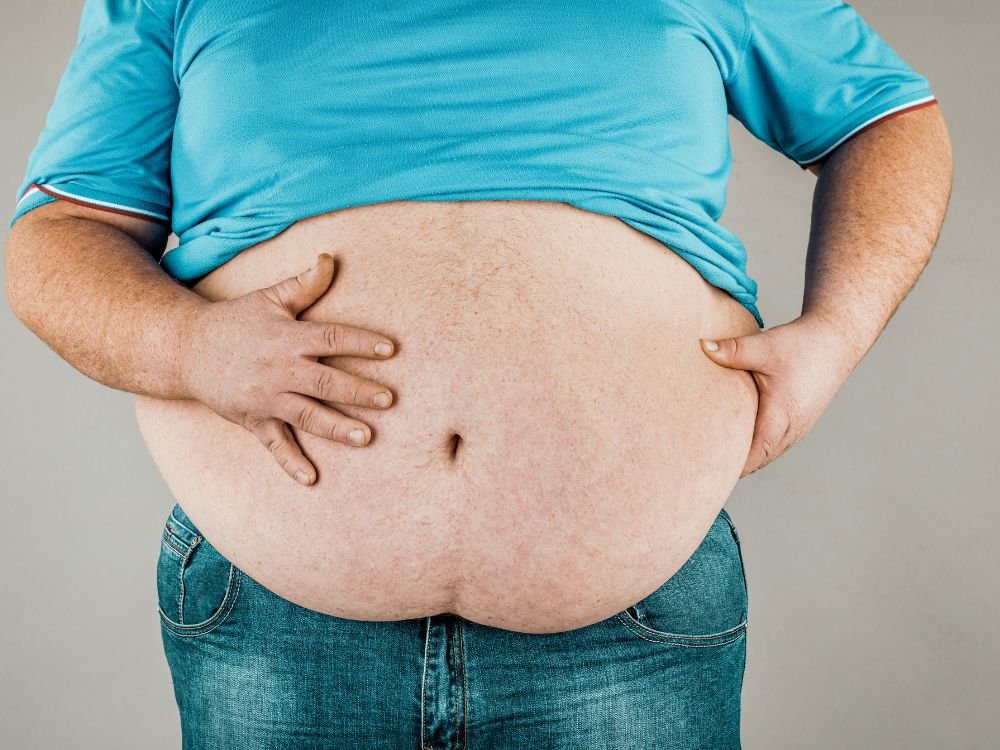 Homem com obesidade abdominal em destaque, evidenciando acúmulo de gordura na região central do corpo.