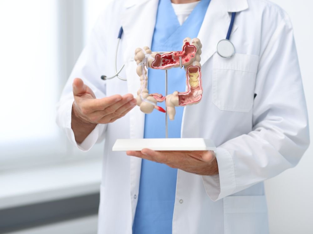 Médico apresentando modelo do intestino com lesões, explicação visual sobre o que é adenoma no intestino e suas alterações