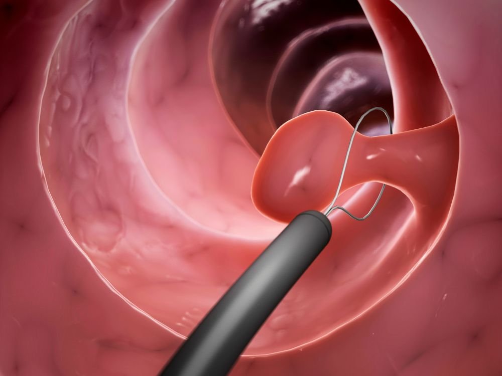 Imagem interna do intestino com instrumento médico, exame que auxilia na análise do que é adenoma no intestino.
