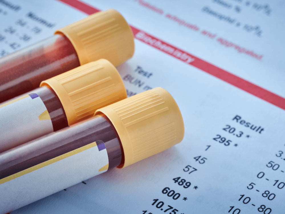 Tubos de coleta com sangue aparecem sobre um laudo de laboratório, ilustrando exames usados na investigação de alterações de saúde.