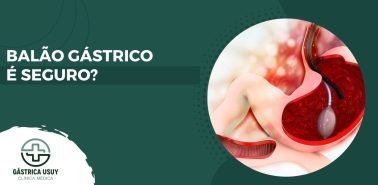 Imagem ilustrativa sobre o procedimento de balão intragástrico com destaque para a pergunta balão gástrico é seguro, abordada pela Clínica Gástrica Usuy.