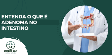 Médico com modelo do intestino em mãos ilustrando o que é adenoma no intestino e alterações que podem surgir no cólon